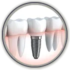 bastrop implant dentistry - Spring St. Dental | Dr Romney & Dr Lasson