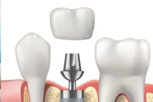 crown placed - Spring St. Dental | Dr Romney & Dr Lasson