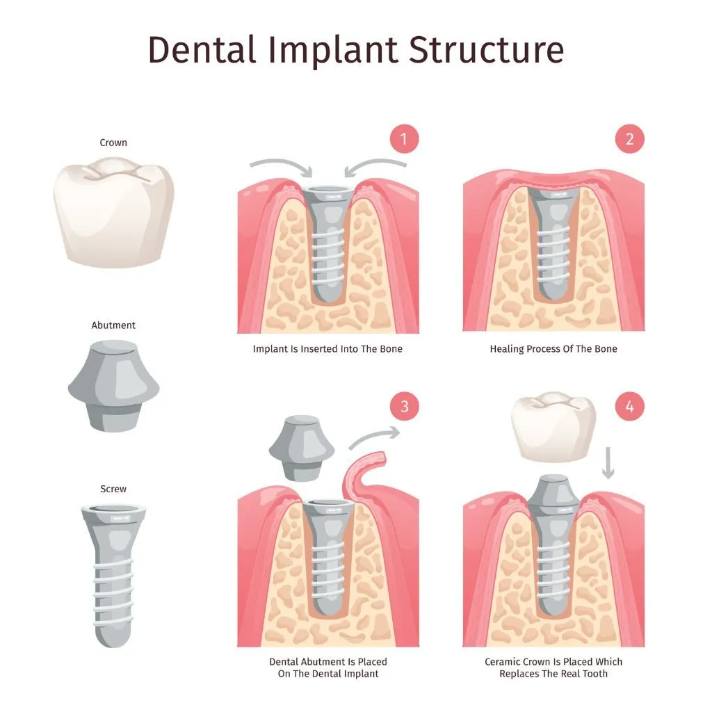 dental implant process - Spring St. Dental | Dr Romney & Dr Lasson