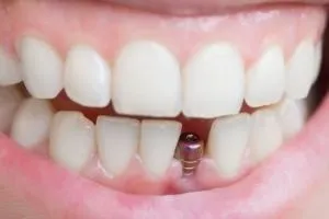 placing in implant - Spring St. Dental | Dr Romney & Dr Lasson