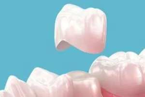 Porcelain Veneers