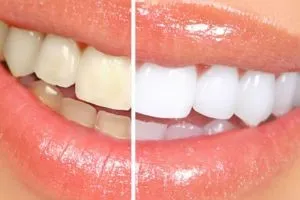 Teeth Whitening