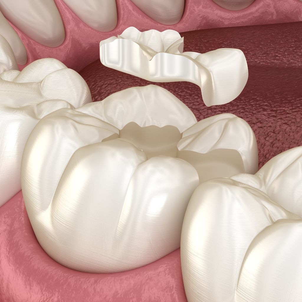 ceramic inlay ct scan