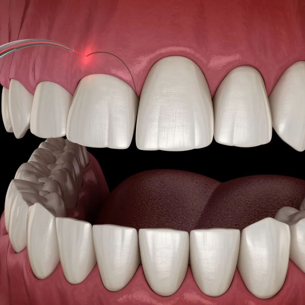 gum contouring procedure - Spring St. Dental | Dr Romney & Dr Lasson