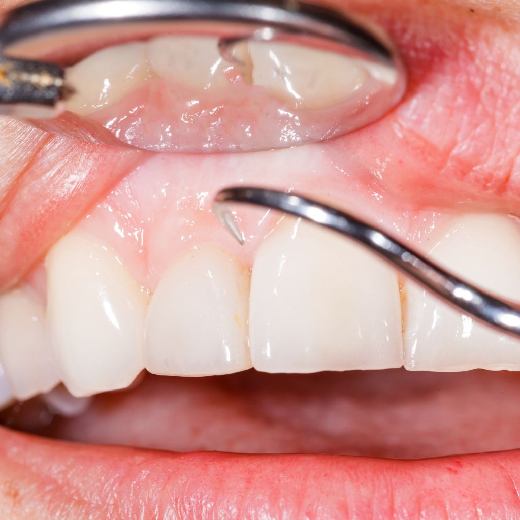 gum disease treatment checkup ct scan