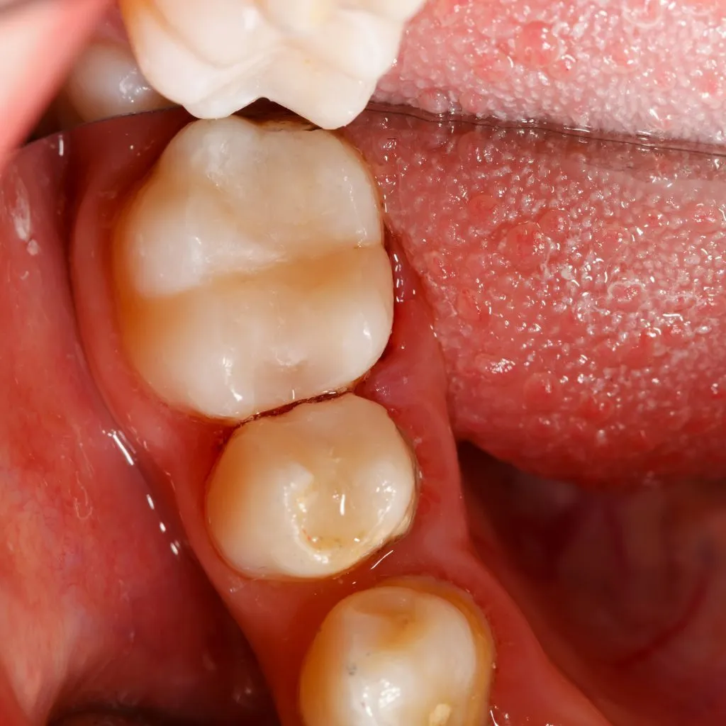 placing in tooth filling - Spring St. Dental | Dr Romney & Dr Lasson