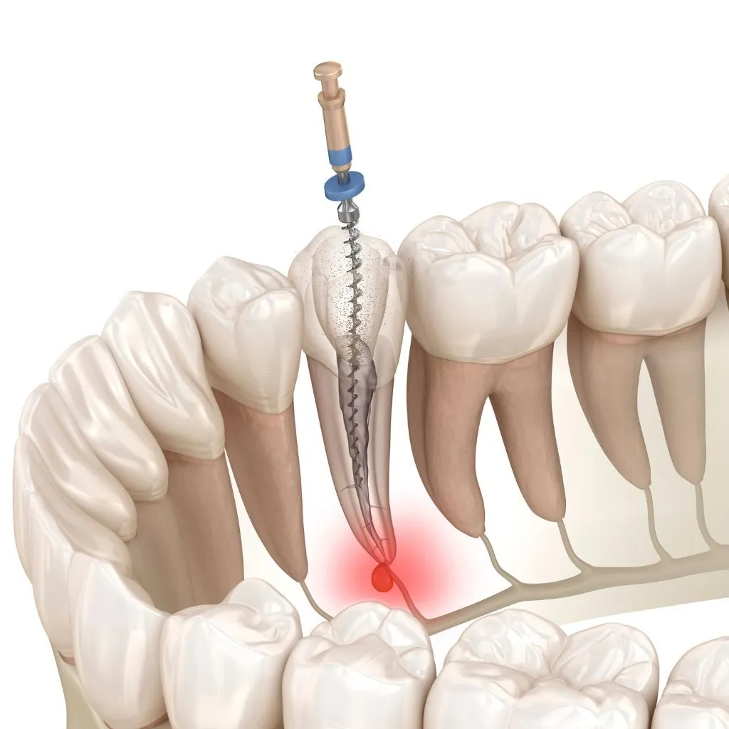root canal cleaning - Spring St. Dental | Dr Romney & Dr Lasson