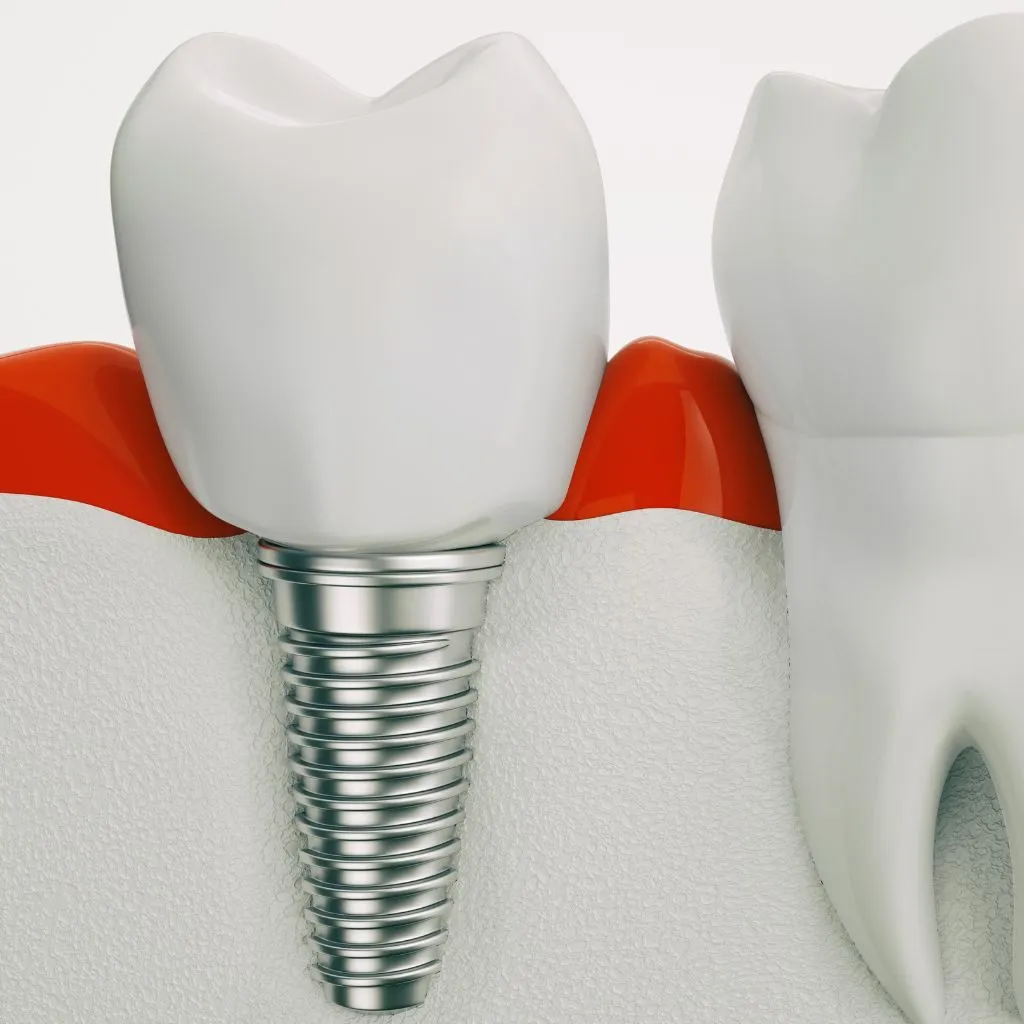 single dental implants - Spring St. Dental | Dr Romney & Dr Lasson