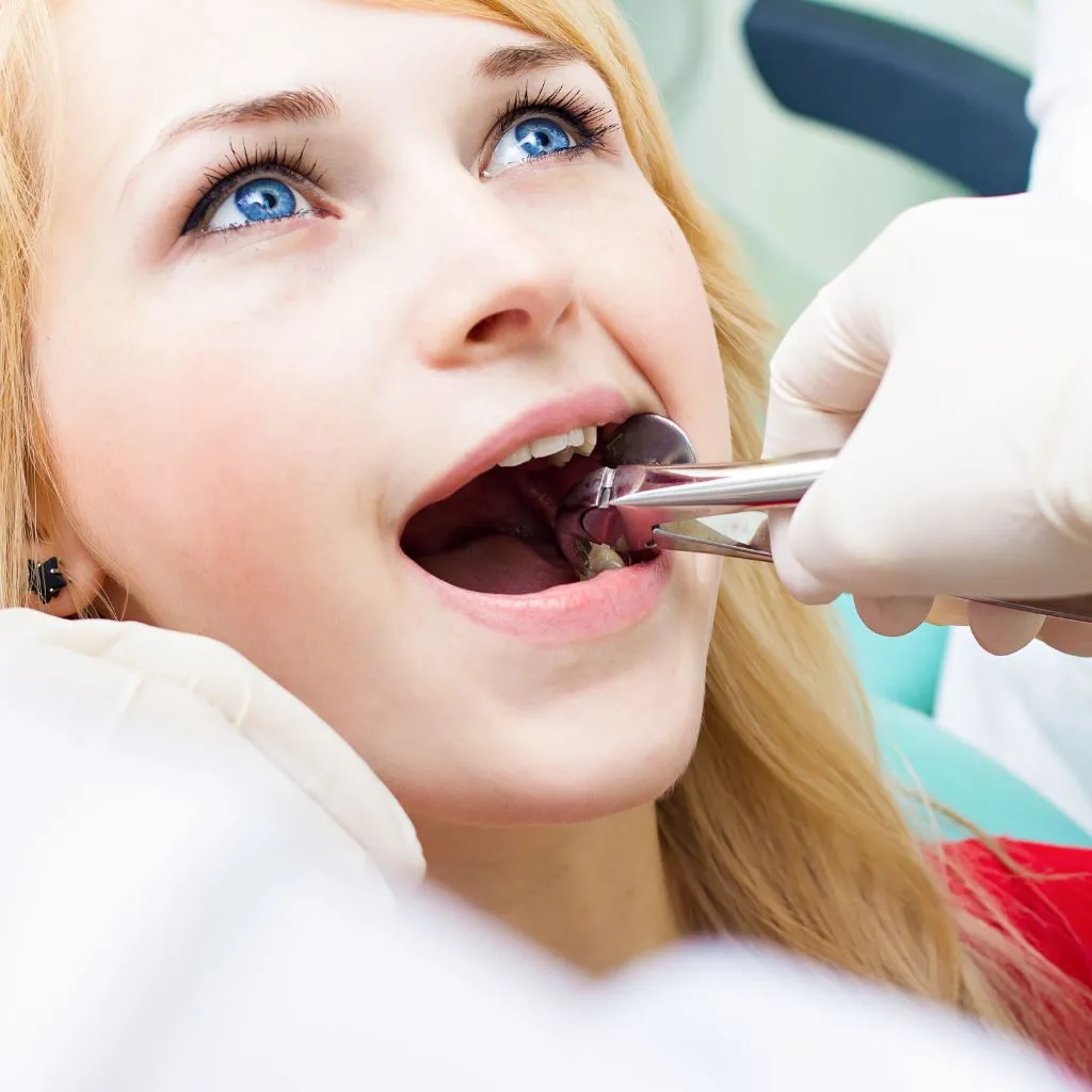 tooth extraction image - Spring St. Dental | Dr Romney & Dr Lasson