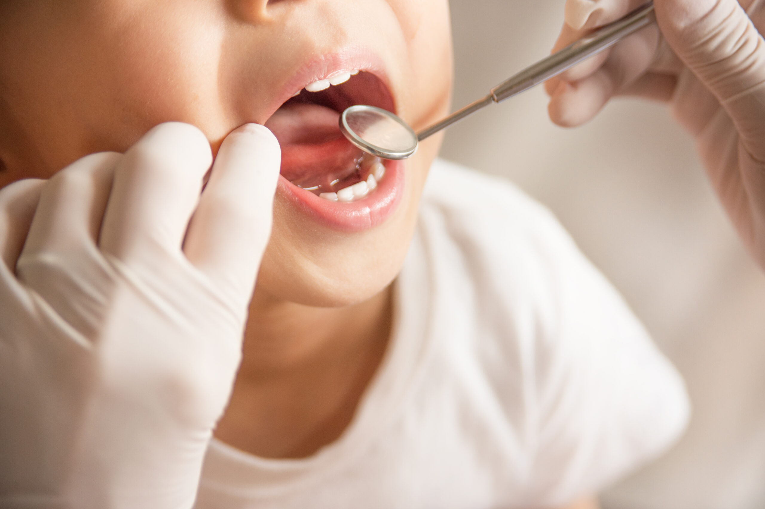 歯のチェック Dental Sealants