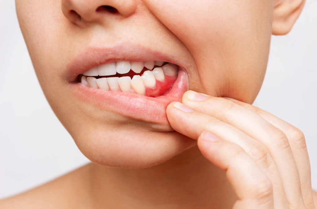 How to Treat Gum Disease When You First Notice Symptoms
