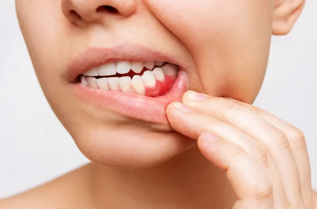 How to Treat Gum Disease When You First Notice Symptoms