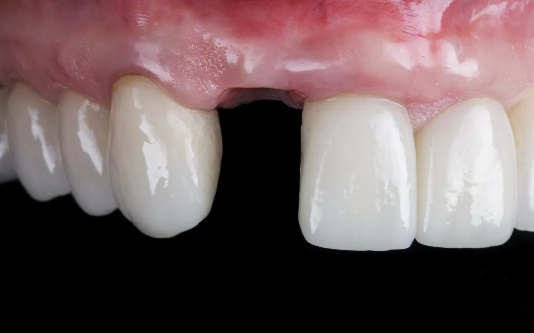What Happens After a Tooth Extraction: Replacement Options Explained